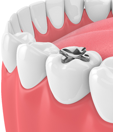 Treatment - Figges Marsh Dental