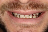 Before - Figges Marsh Dental