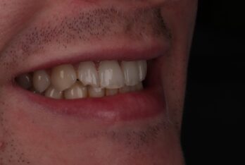 Before - Figges Marsh Dental