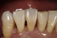 After - Figges Marsh Dental