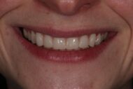 After - Figges Marsh Dental