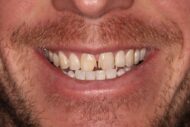 Before - Figges Marsh Dental