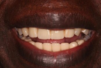 After - Figges Marsh Dental