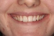 Before - Figges Marsh Dental