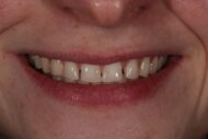 Before - Figges Marsh Dental