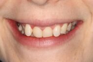 Before - Figges Marsh Dental