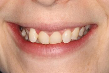 Before - Figges Marsh Dental