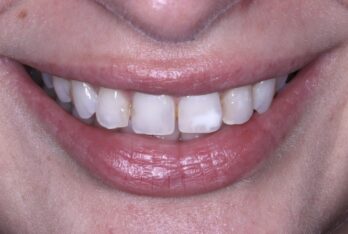 Before - Figges Marsh Dental