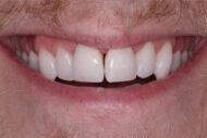 After - Figges Marsh Dental