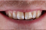 Before - Figges Marsh Dental