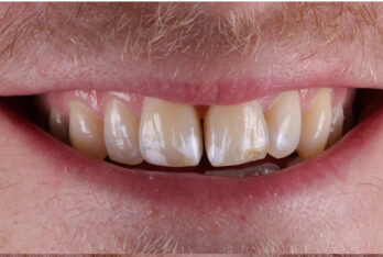 Before - Figges Marsh Dental